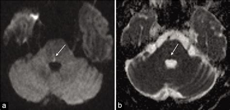 Internuclear Ophthalmoplegia Mri