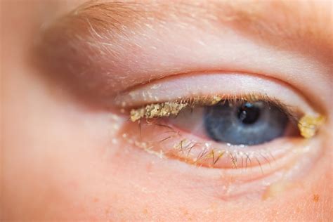 Sticky eyes in babies and toddlers - HSE.ie