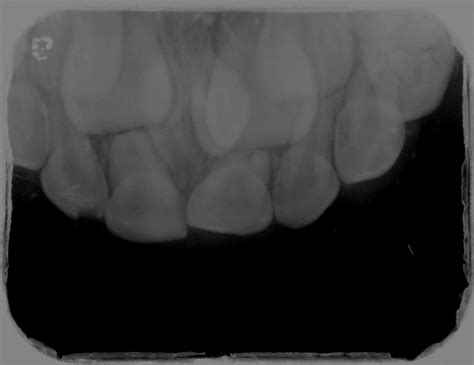 Case #2 Diagnoses: Developing Mesiodens - Radiographic Interpretations - Dentalcare