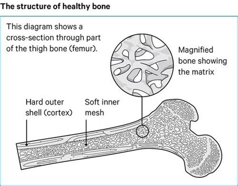 Osteomalacia Diagram