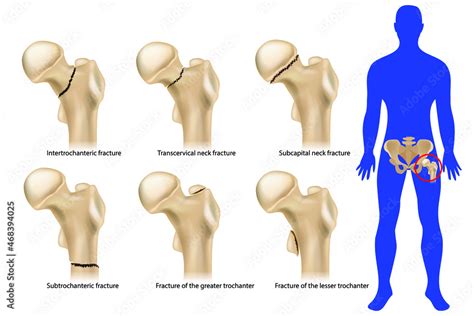 Femoral neck fracture. Types of hip fractures. Subtrochanteric, Intertrochanteric, Transcervical ...