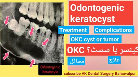 Odontogenic keratocyst | Treatment | Complications | OKC cyst or tumor? | - YouTube