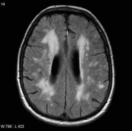 Multi Infarct Dementia Life Expectancy