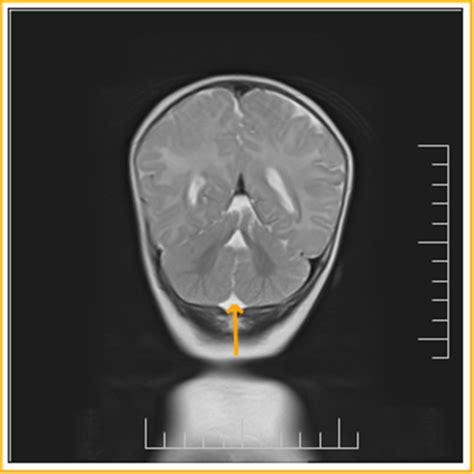 Joubert's Syndrome-MRI - Sumer's Radiology Blog