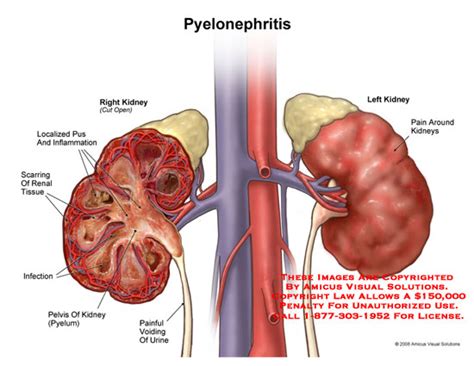 Pyelonephritis