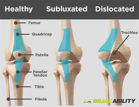 Patellar Subluxation (Partially Dislocated Kneecap) | Subluxation, Patellar tracking disorder ...