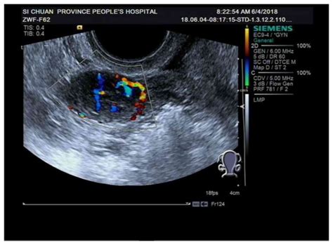 Ovarian Fibroma Ultrasound