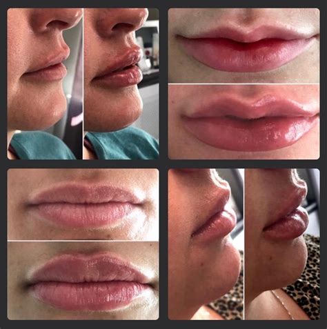 Our new lip filler: Restylane Kysse: Transformed Aesthetic and Wellness Center: Laser & Medical Spa