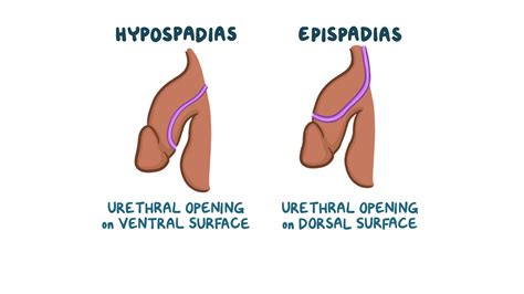 Hypospadias and epispadias: Nursing - Osmosis Video Library