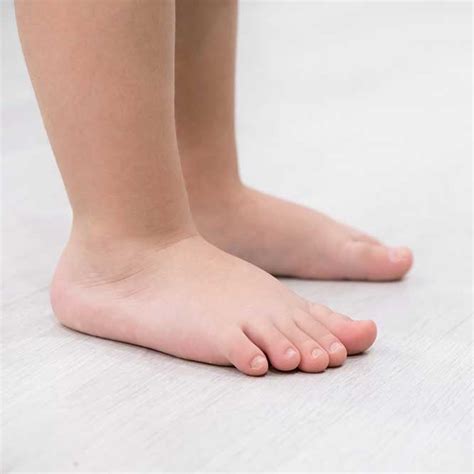 Children's Flat Feet - What Every Parent Should Know