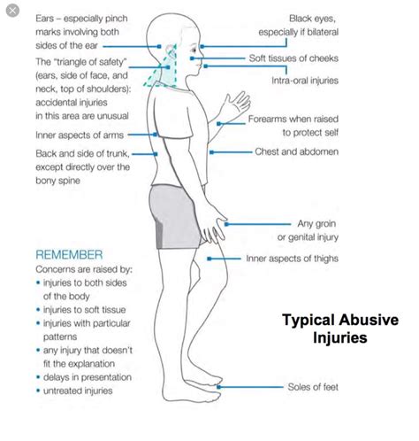 Physical Abuse Signs