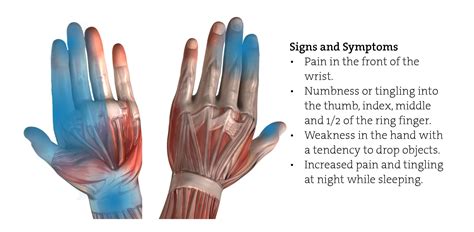 Carpal Tunnel Syndrome (CTS) In The Workplace - Healthscreen UK