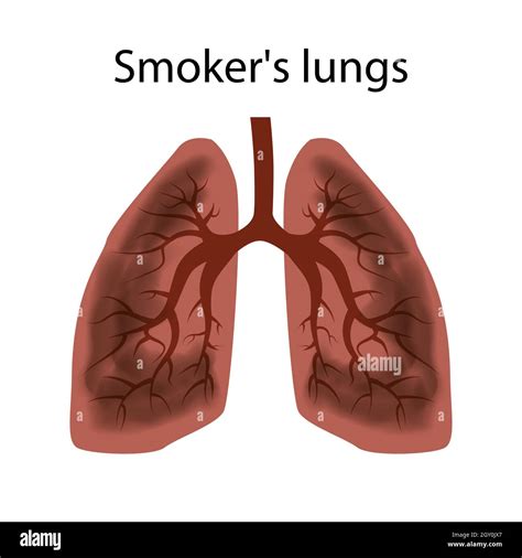 Non Smoker Lungs Vs Smoker