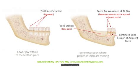 Dental Implant Dentist | Implant Surgery