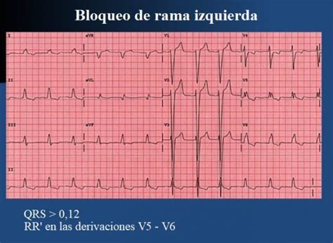 Bloqueo de rama, derecha, izquierda, corazón, causas, tratamiento y ...