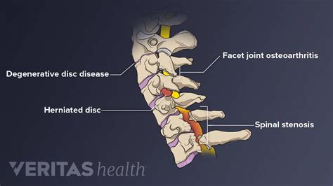 Cervical Intervertebral Foramen