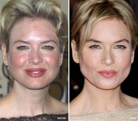 Rosacea Celebrities