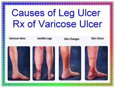 Causes of leg ulcer Rx of varicose ulcer | Leg ulcers, Varicose ulcer, Ulcers