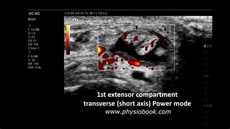 Tendinitis De Quervain Ultrasound