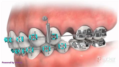 Orthodontic Mini-Implant (TAD or TSA) - YouTube