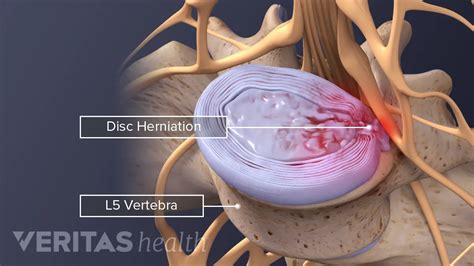 Protrusion L4/5 - Pregnant Health Tips