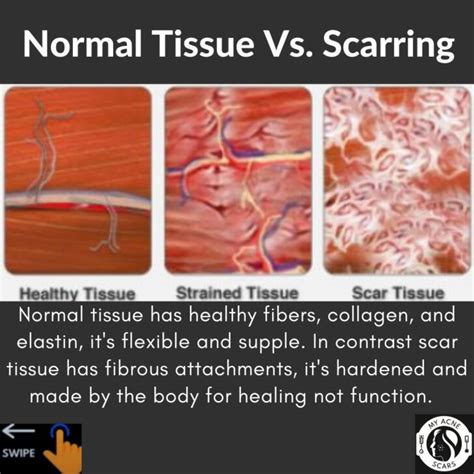 Scar Tissue Vs Normal Skin - My Acne Scars