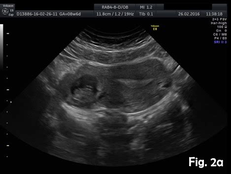 Ultrasound diagnosis of uncomplicated interstitial pregnancy [May 2016 ...