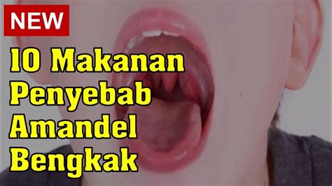 10 Makanan Penyebab Amandel Bengkak - YouTube