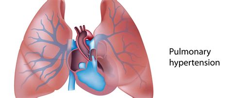 Pulmonary Hypertension Explained by a Cardiologist • MyHeart