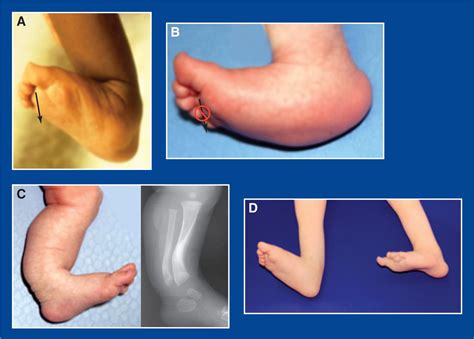 Foot and Ankle Deformities | Musculoskeletal Key