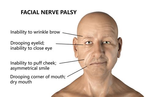 Coronavirus: Man has Bell's palsy after both Pfizer jabs