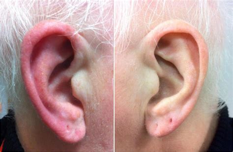 Red ears: Symptoms, causes, and treatment