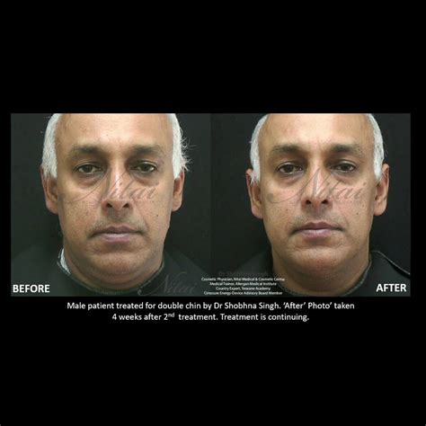 Double Chin Reduction Melbourne | Chin Fat Dissolving Injections at Nitai