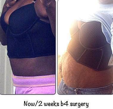 Full tummy tuck procedure before and after photos » Tummy Tuck: Prices ...