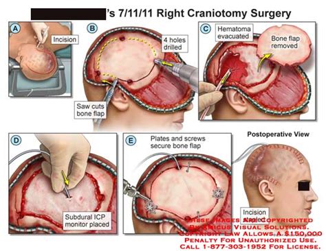 AMICUS Illustration of amicus,surgery,craniotomy,skull,bone,incision,saw,flap,hematoma,evacuated ...