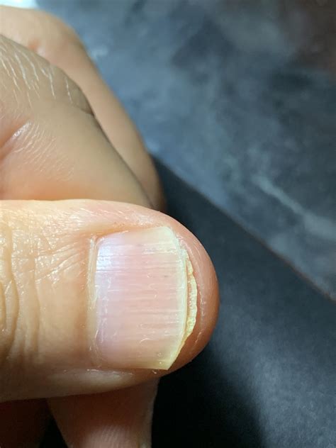 Is this nail fungus? : r/NailFungus