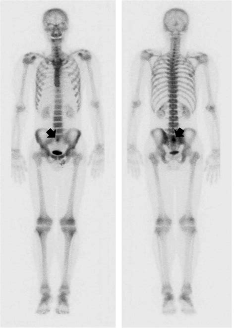 Bone scintigraphy shows increased uptake in the middle of the second ...