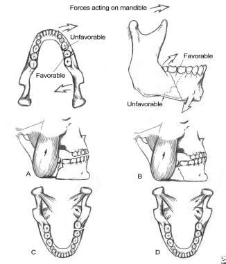 Mandible Fracture