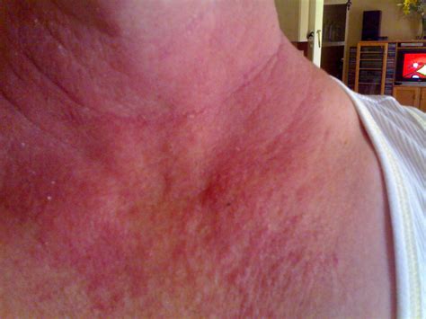 I have a rash on my neck and V-shap on my chest. It is itching