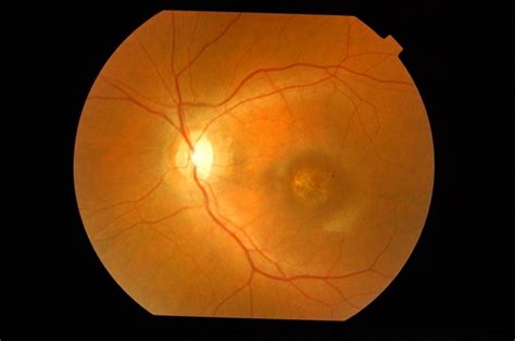 Macular Dystrophy - Retina Image Bank