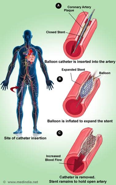 Coronary Balloon Angioplasty