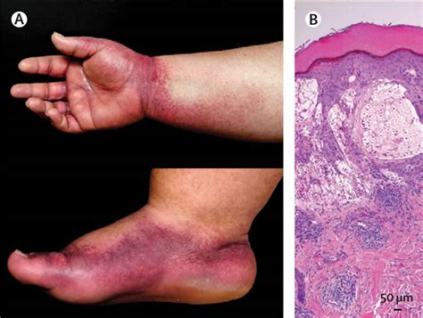 Papular purpuric gloves and socks syndrome, causes, symptoms, diagnosis ...