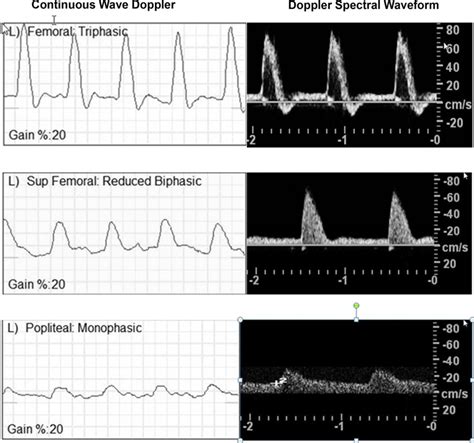 Arterial waveform | Medical ultrasound, Ultrasound, Vascular ultrasound