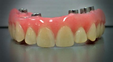 Fixed Implant Retained Hybrid Dentures - ProCare Denture Clinic ...