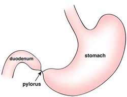 Intestinal Atresia & Stenosis | Types, Diagnosis & Treatment