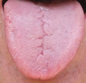 What is Fissured Tongue? - Geographic Tongue | Healthy Tongue Secrets