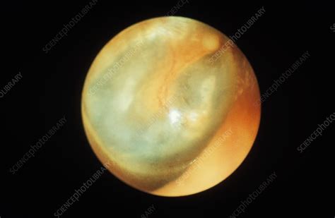 Eardrum, otoscope view - Stock Image C023/5989 - Science Photo Library