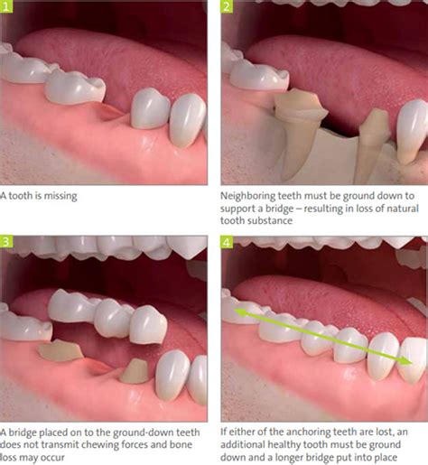 Benefits of Dental Implants | LuxDen Implants Center Brooklyn NY