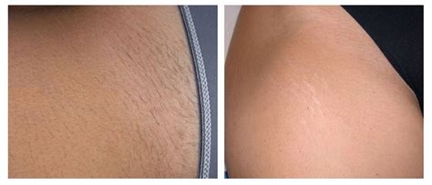 Before and After | Renova Laser Hair Removal & MedSpa Houston TX