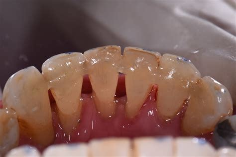 Stabilizing Mobile Teeth | Periodontal Splinting